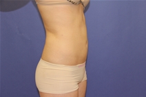 Liposuction After Photo by Moneer Jaibaji, MD; Coronado, CA - Case 23446