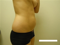 Liposuction Before Photo by Moneer Jaibaji, MD; Coronado, CA - Case 23446