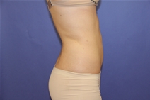 Liposuction After Photo by Moneer Jaibaji, MD; Coronado, CA - Case 23446