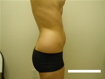 Liposuction Before Photo by Moneer Jaibaji, MD; Coronado, CA - Case 23446