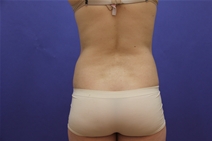 Liposuction After Photo by Moneer Jaibaji, MD; Coronado, CA - Case 23446