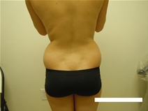 Liposuction Before Photo by Moneer Jaibaji, MD; Coronado, CA - Case 23446