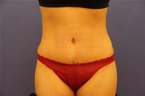 Tummy Tuck After Photo by Moneer Jaibaji, MD; Coronado, CA - Case 23447