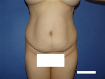 Tummy Tuck Before Photo by Moneer Jaibaji, MD; Coronado, CA - Case 23447