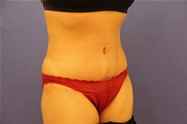 Tummy Tuck After Photo by Moneer Jaibaji, MD; Coronado, CA - Case 23447