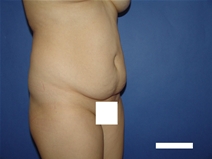Tummy Tuck Before Photo by Moneer Jaibaji, MD; Coronado, CA - Case 23447