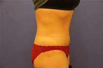 Tummy Tuck After Photo by Moneer Jaibaji, MD; Coronado, CA - Case 23447