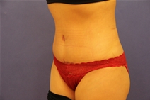 Tummy Tuck After Photo by Moneer Jaibaji, MD; Coronado, CA - Case 23447