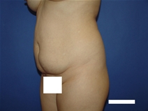 Tummy Tuck Before Photo by Moneer Jaibaji, MD; Coronado, CA - Case 23447