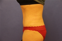 Tummy Tuck After Photo by Moneer Jaibaji, MD; Coronado, CA - Case 23447