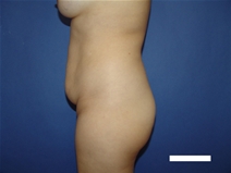 Tummy Tuck Before Photo by Moneer Jaibaji, MD; Coronado, CA - Case 23447