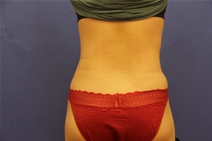 Tummy Tuck After Photo by Moneer Jaibaji, MD; Coronado, CA - Case 23447