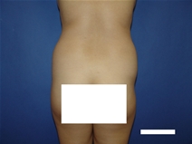 Tummy Tuck Before Photo by Moneer Jaibaji, MD; Coronado, CA - Case 23447