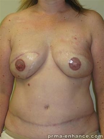 Breast Reconstruction After Photo by Minas Chrysopoulo, MD, FACS; San Antonio, TX - Case 23308