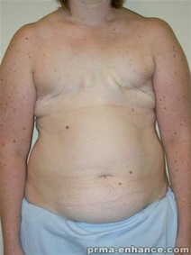 Breast Reconstruction Before Photo by Minas Chrysopoulo, MD, FACS; San Antonio, TX - Case 23308