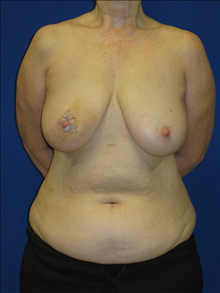 Breast Reconstruction Before Photo by Minas Chrysopoulo, MD, FACS; San Antonio, TX - Case 24084