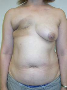 Breast Reconstruction Before Photo by Minas Chrysopoulo, MD, FACS; San Antonio, TX - Case 24088