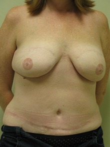 Breast Reconstruction After Photo by Minas Chrysopoulo, MD, FACS; San Antonio, TX - Case 24089