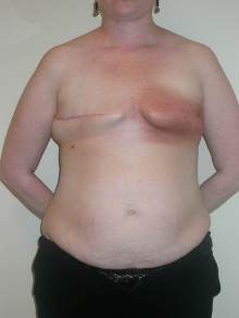 Breast Reconstruction Before Photo by Minas Chrysopoulo, MD, FACS; San Antonio, TX - Case 24089