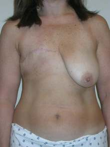 Breast Reconstruction Before Photo by Minas Chrysopoulo, MD, FACS; San Antonio, TX - Case 24099