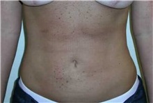 Liposuction After Photo by Minas Chrysopoulo, MD, FACS; San Antonio, TX - Case 29998