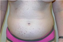 Liposuction Before Photo by Minas Chrysopoulo, MD, FACS; San Antonio, TX - Case 29998