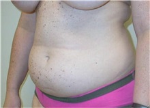 Liposuction Before Photo by Minas Chrysopoulo, MD, FACS; San Antonio, TX - Case 29998