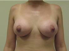 Breast Augmentation After Photo by Minas Chrysopoulo, MD, FACS; San Antonio, TX - Case 29999