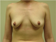 Breast Augmentation Before Photo by Minas Chrysopoulo, MD, FACS; San Antonio, TX - Case 29999