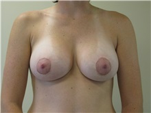 Breast Augmentation After Photo by Minas Chrysopoulo, MD, FACS; San Antonio, TX - Case 30000