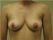 Breast Augmentation Before Photo by Minas Chrysopoulo, MD, FACS; San Antonio, TX - Case 30000