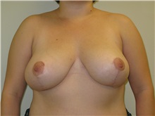 Breast Reduction After Photo by Minas Chrysopoulo, MD, FACS; San Antonio, TX - Case 30001