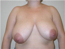 Breast Reduction Before Photo by Minas Chrysopoulo, MD, FACS; San Antonio, TX - Case 30001