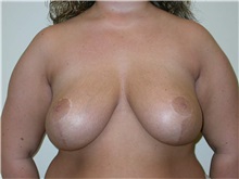 Breast Reduction After Photo by Minas Chrysopoulo, MD, FACS; San Antonio, TX - Case 30002