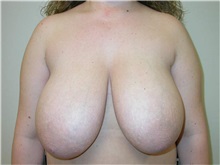 Breast Reduction Before Photo by Minas Chrysopoulo, MD, FACS; San Antonio, TX - Case 30002