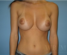 Breast Augmentation After Photo by William Bruno, MD; West Hollywood, CA - Case 51319