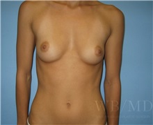 Breast Augmentation Before Photo by William Bruno, MD; West Hollywood, CA - Case 51319