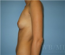 Breast Augmentation Before Photo by William Bruno, MD; West Hollywood, CA - Case 51319