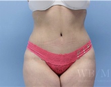 Tummy Tuck After Photo by William Bruno, MD; West Hollywood, CA - Case 51320