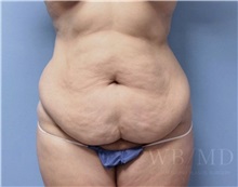 Tummy Tuck Before Photo by William Bruno, MD; West Hollywood, CA - Case 51320