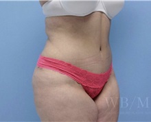 Tummy Tuck After Photo by William Bruno, MD; West Hollywood, CA - Case 51320
