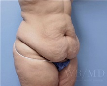 Tummy Tuck Before Photo by William Bruno, MD; West Hollywood, CA - Case 51320
