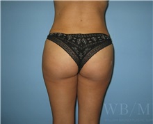 Buttock Lift with Augmentation After Photo by William Bruno, MD; West Hollywood, CA - Case 51323