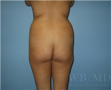 Buttock Lift with Augmentation Before Photo by William Bruno, MD; West Hollywood, CA - Case 51323