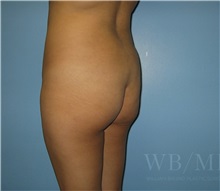 Buttock Lift with Augmentation Before Photo by William Bruno, MD; West Hollywood, CA - Case 51323