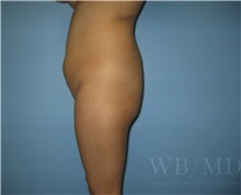 Buttock Lift with Augmentation Before Photo by William Bruno, MD; West Hollywood, CA - Case 51323
