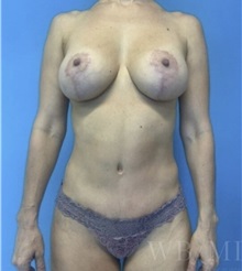 Mommy Makeover After Photo by William Bruno, MD; West Hollywood, CA - Case 51321
