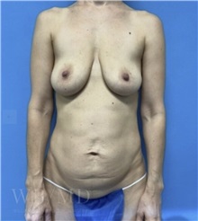 Mommy Makeover Before Photo by William Bruno, MD; West Hollywood, CA - Case 51321