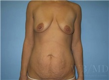 Mommy Makeover Before Photo by William Bruno, MD; West Hollywood, CA - Case 51324