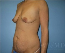 Mommy Makeover Before Photo by William Bruno, MD; West Hollywood, CA - Case 51324